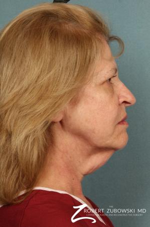 Facelift: Patient 23 - Before and After Image 2