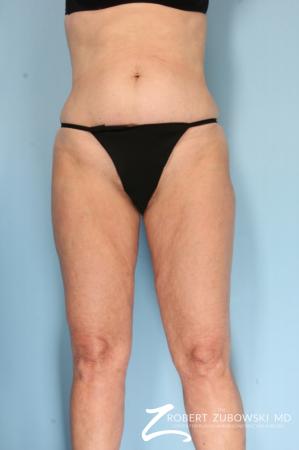 Liposuction: Patient 46 - After Image 1