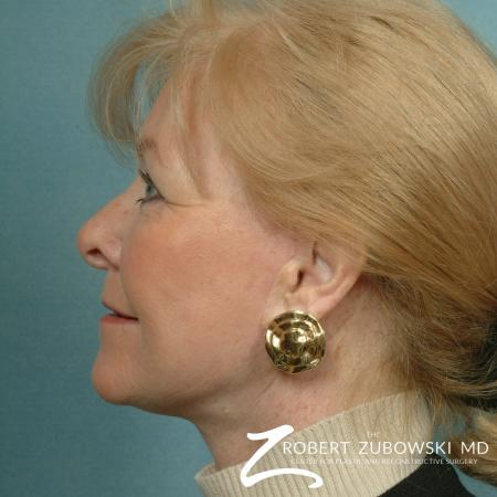 Facelift: Patient 16 - After Image 2