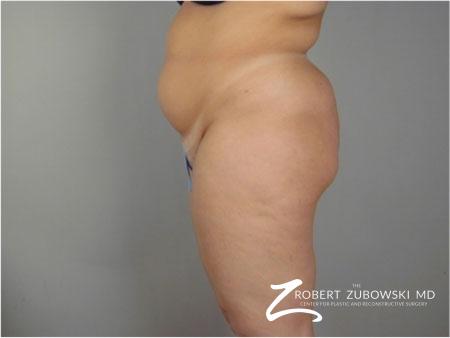 Liposuction: Patient 41 - Before Image 2