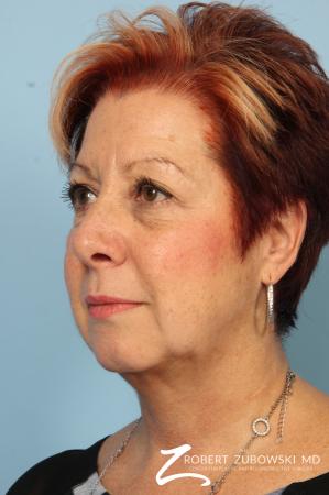 Blepharoplasty: Patient 13 - Before and After Image 2