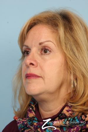 Blepharoplasty: Patient 34 - After Image 2