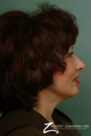 Laser: Patient 1 - After Image 1