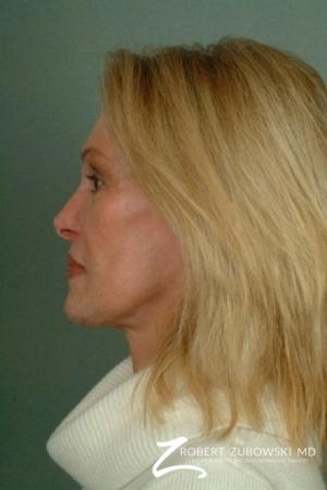 Facelift: Patient 12 - After Image 2