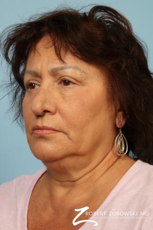 Blepharoplasty: Patient 31 - After Image 2