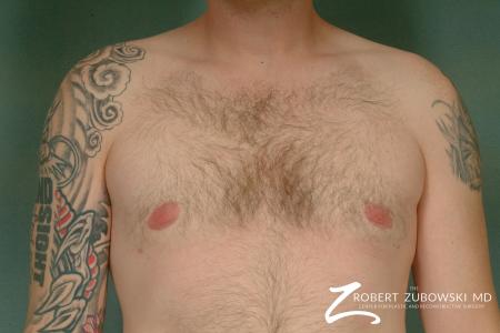 Gynecomastia: Patient 2 - After Image 1