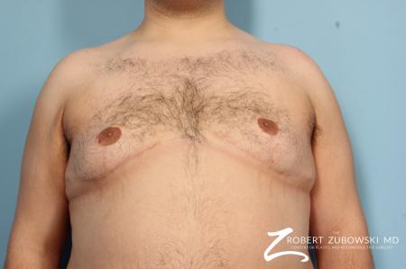 Gynecomastia: Patient 6 - After Image 1
