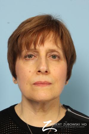 Blepharoplasty: Patient 14 - After Image 1