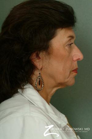 Brow Lift: Patient 6 - Before and After Image 2
