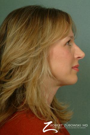Rhinoplasty: Patient 10 - After Image 3