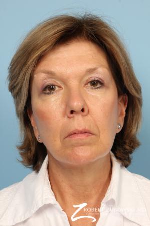 Facelift: Patient 18 - After Image 1