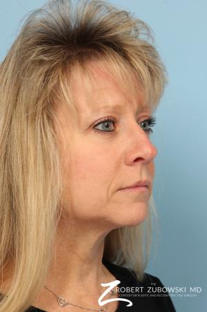 Blepharoplasty: Patient 28 - After Image 2