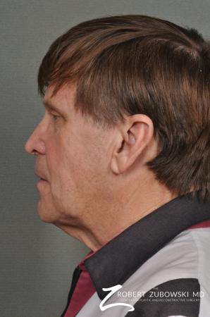 Neck Lift: Patient 3 - Before and After Image 3
