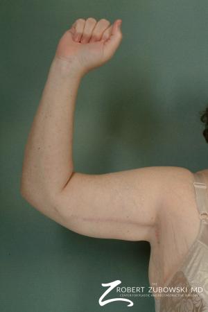 Arm Lift: Patient 3 - After Image 3
