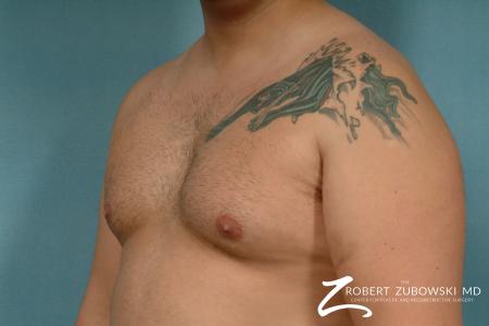 Gynecomastia: Patient 9 - Before and After Image 2
