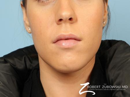 Permanent Lip Enhancement: Patient 2 - After Image 1