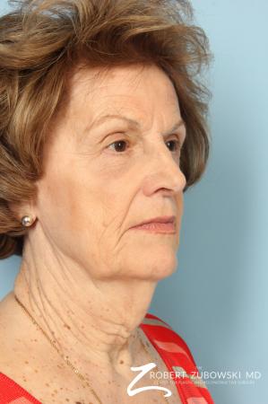 Blepharoplasty: Patient 36 - After Image 2