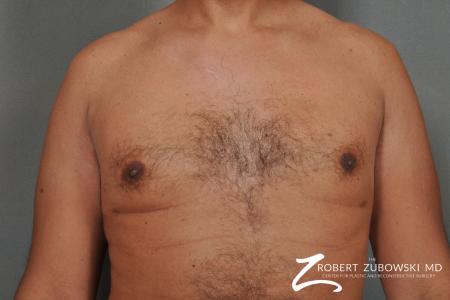 Gynecomastia: Patient 8 - After Image 1