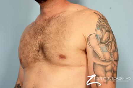 Gynecomastia: Patient 10 - After Image 2