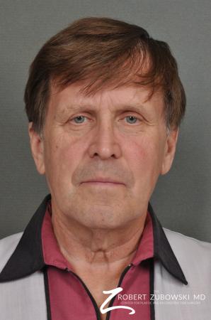 Neck Lift: Patient 3 - Before Image 1