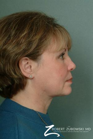 Chin Augmentation: Patient 2 - After Image 2