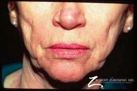 Laser: Patient 8 - Before Image 1