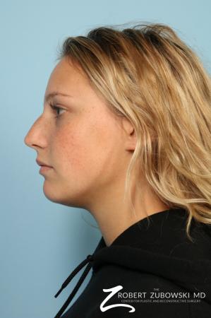 Rhinoplasty: Patient 23 - Before and After Image 2