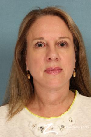 Blepharoplasty: Patient 22 - After Image 1