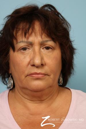 Blepharoplasty: Patient 31 - After Image 1