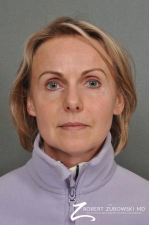 BOTOX® Cosmetic: Patient 2 - After Image 1