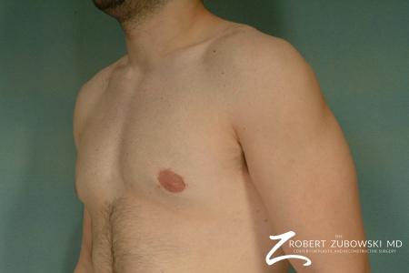 Gynecomastia: Patient 1 - After Image 2