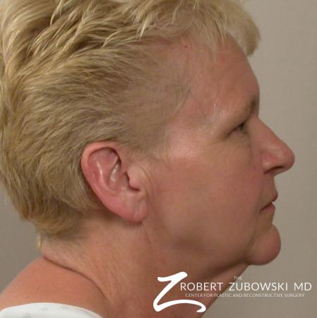 Facelift: Patient 14 - Before and After Image 2
