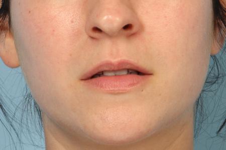 Fillers: Patient 1 - Before Image 1