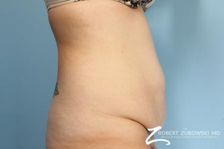 Tummy Tuck: Patient 17 - Before and After Image 2
