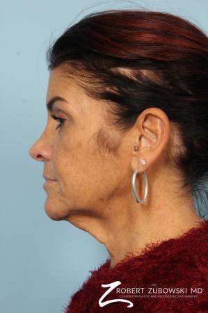 Neck Lift: Patient 10 - Before and After Image 3