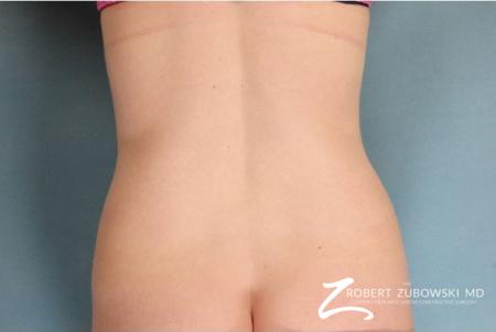 Liposuction: Patient 36 - After Image 1