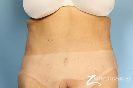 CoolSculpting®: Patient 2 - After Image 1