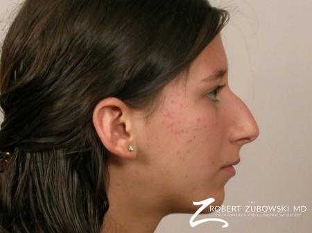 Rhinoplasty: Patient 8 - Before and After Image 2