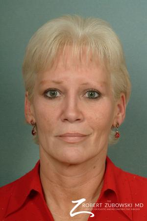 Facelift: Patient 7 - Before Image 1
