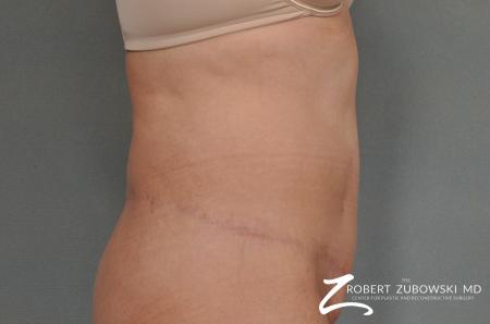 Tummy Tuck: Patient 7 - After Image 2