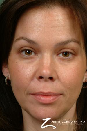 Fillers: Patient 2 - Before Image 1
