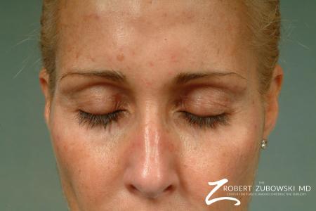 Latisse: Patient 3 - After Image 1