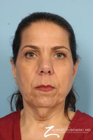 Chin Augmentation: Patient 4 - Before Image 1