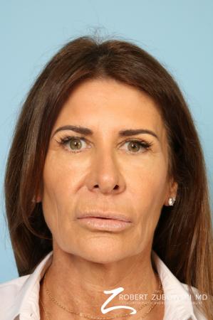 Lip Augmentation: Patient 1 - Before Image 1