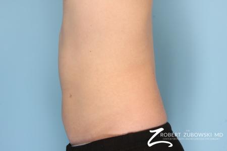 Liposuction: Patient 16 - After Image 2