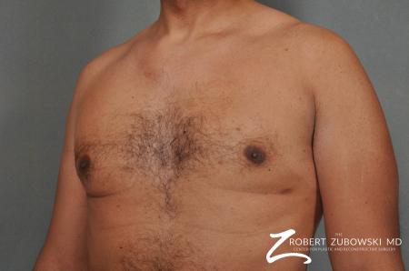 Gynecomastia: Patient 8 - After Image 2