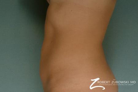 Liposuction: Patient 26 - After Image 2