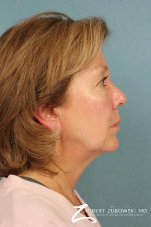 Facelift: Patient 18 - Before and After Image 2