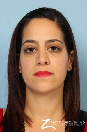 Rhinoplasty: Patient 15 - After Image 1