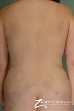 Liposuction: Patient 2 - After Image 1